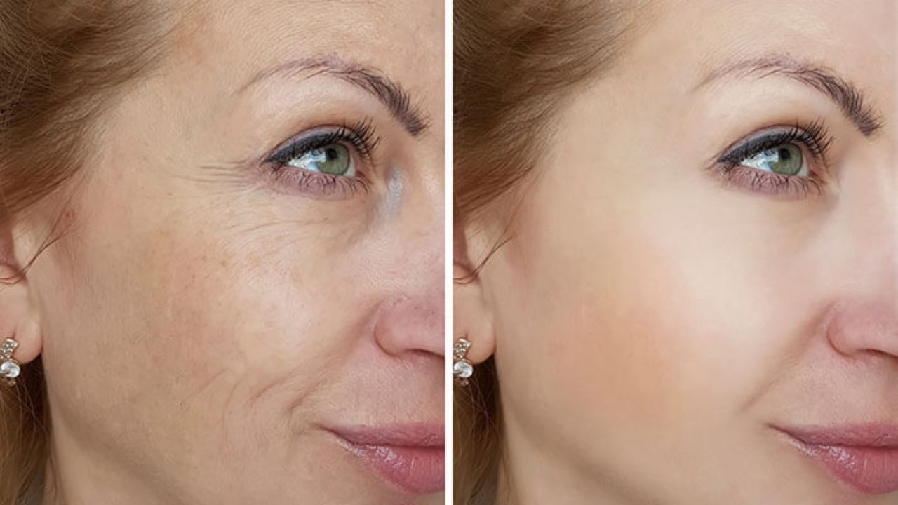 5 Amazing Benefits Of Microneedling For You To Know