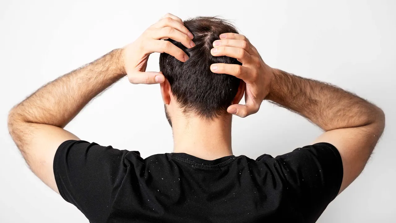 5 Beneficial Tips To Follow On How To Get Rid Of Dandruff