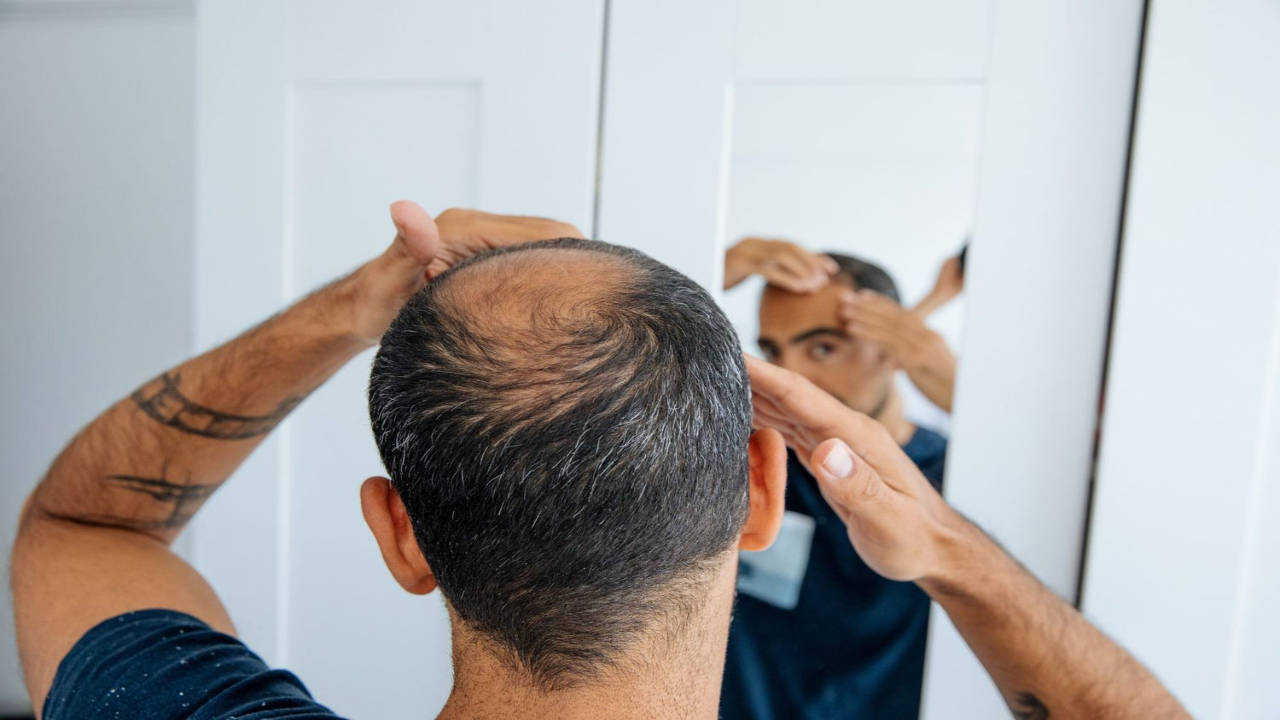 5 Best Hair Loss Treatment Names One Should Know