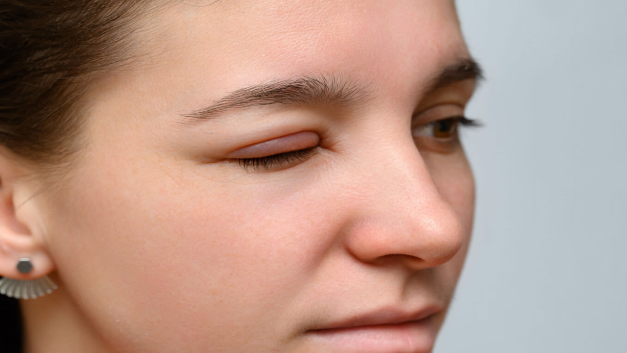 5 Common Reasons For A Swollen Eyelid