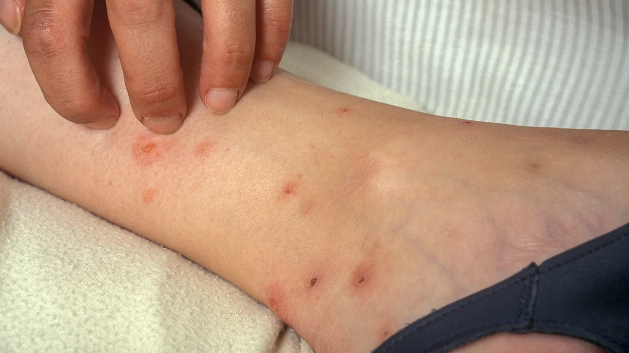 5 Common Symptoms Of Bed Bug Bites