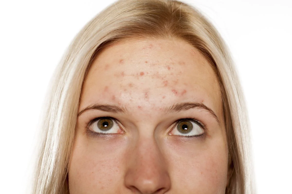 5 Important Tips On How To Get Rid Of Forehead Acne