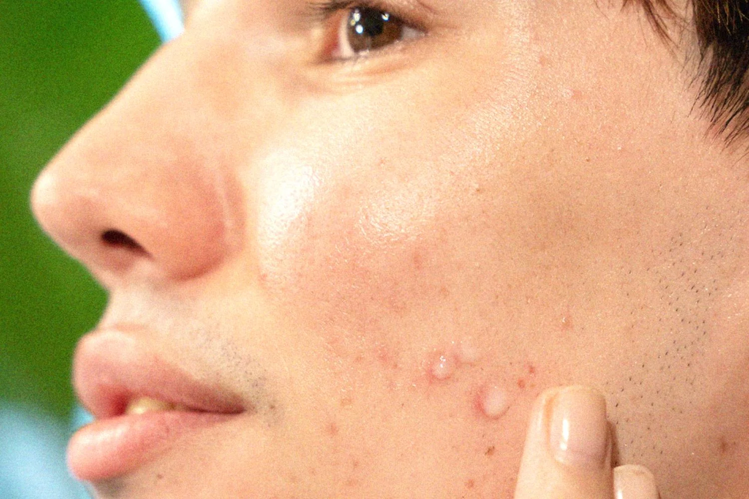 All You Need To Know About Pimple Scars