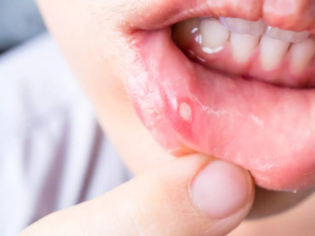 4 Best Tips To Remove Mouth Sores
