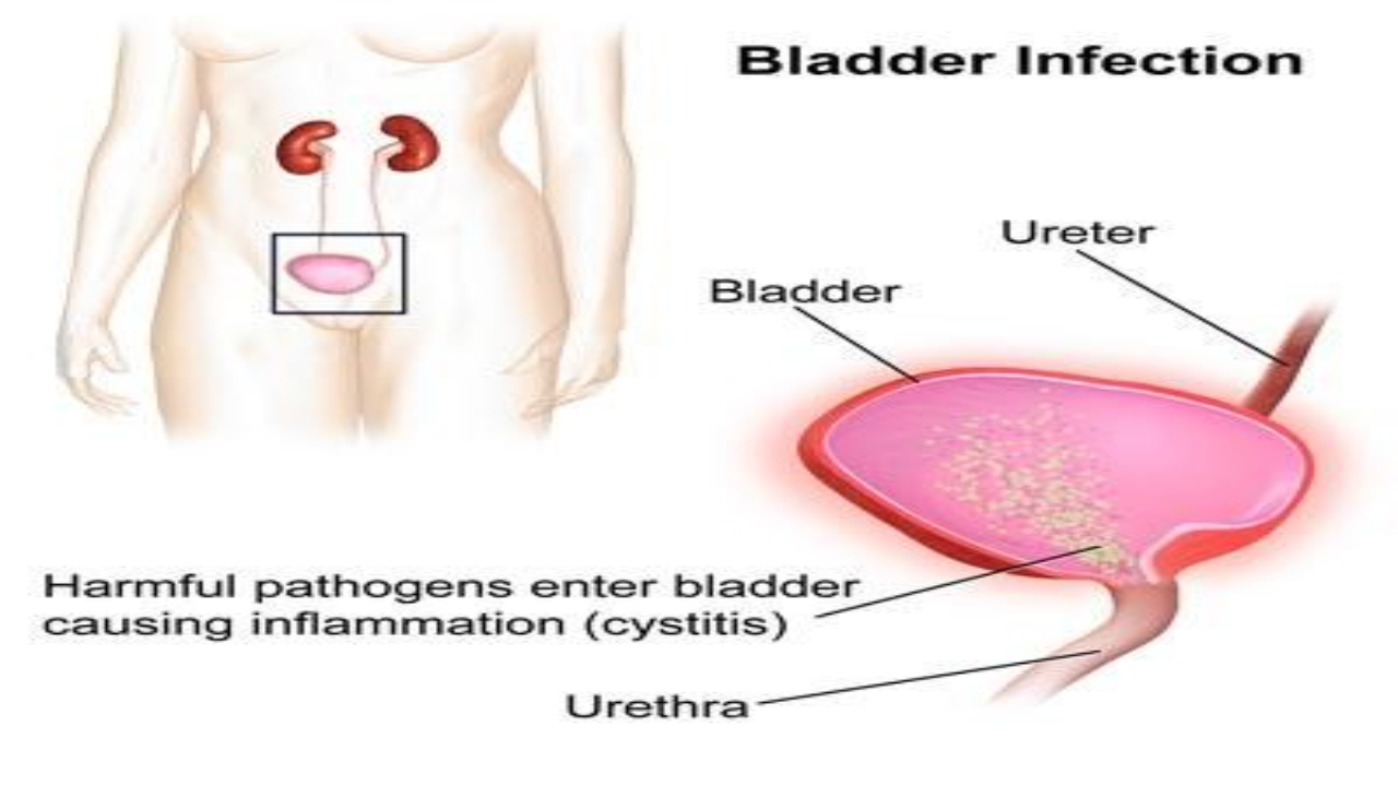 5 Best Home Remedies For Uti