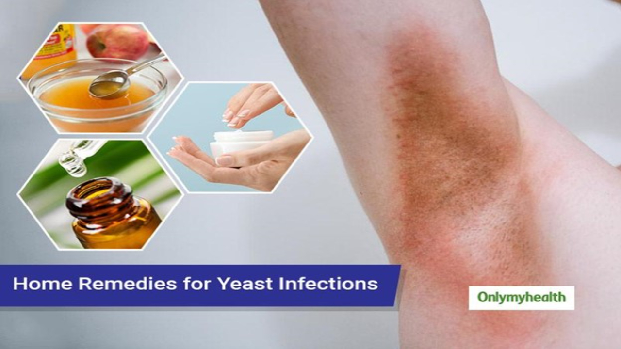 5 Best Yeast Infection Home Remedies