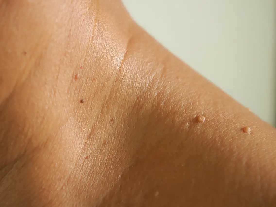 5 Tips On How To Get Rid Of Skin Tags
