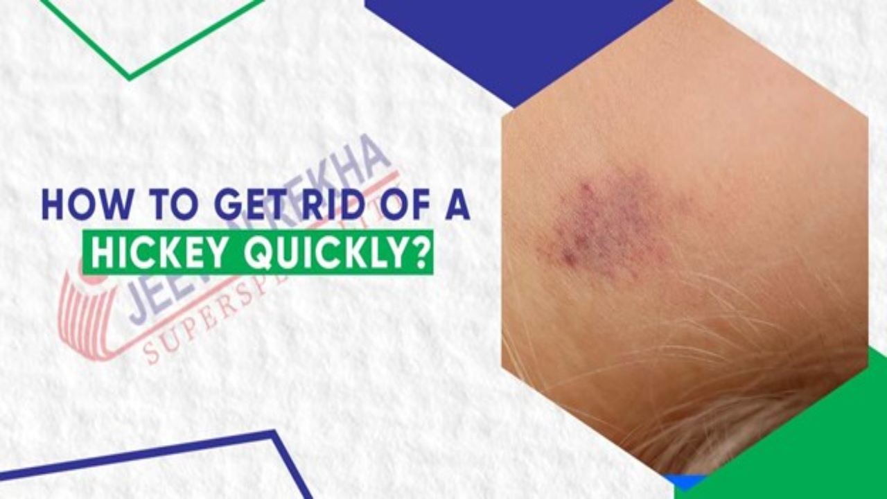How To Get Rid Of Hickeys? Know 5 Best Methods