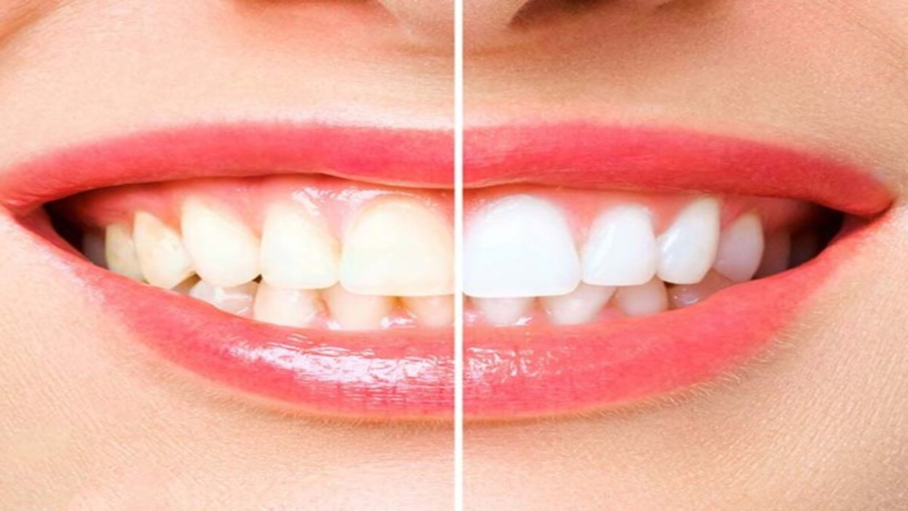 How To Naturally Whiten Teeth? Know The Tips