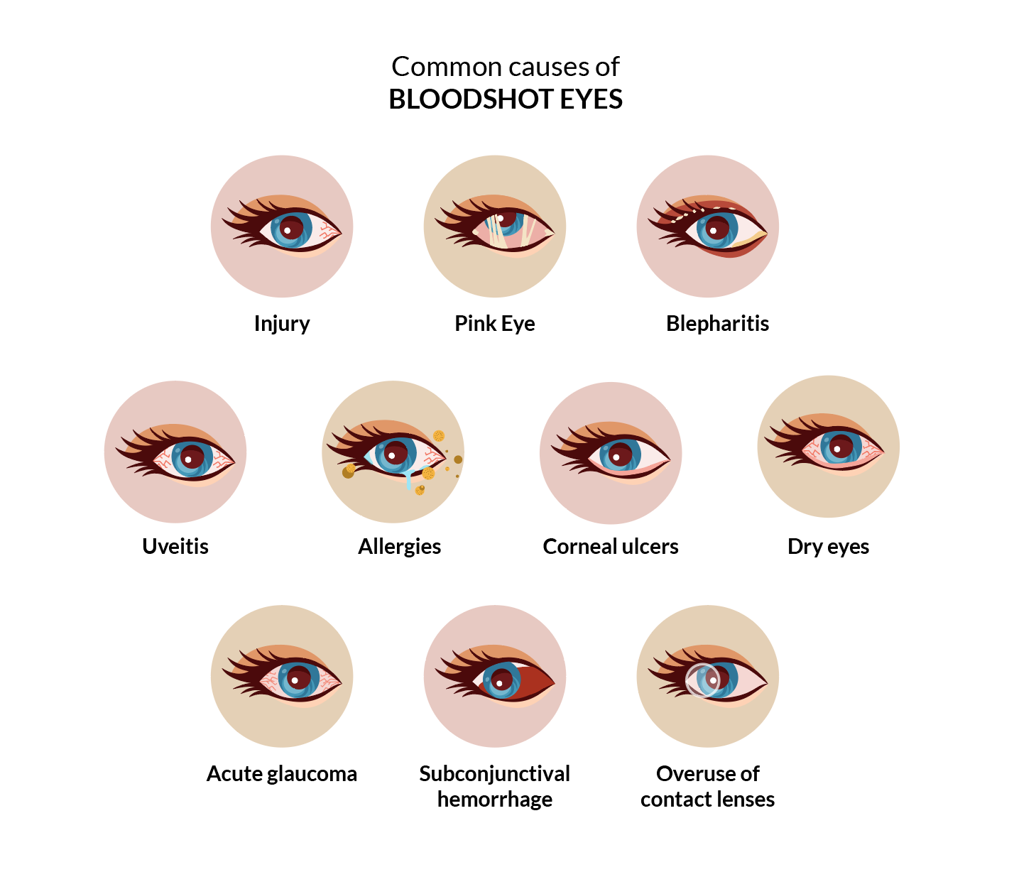 What Are The Common Causes Of Eye Redness?