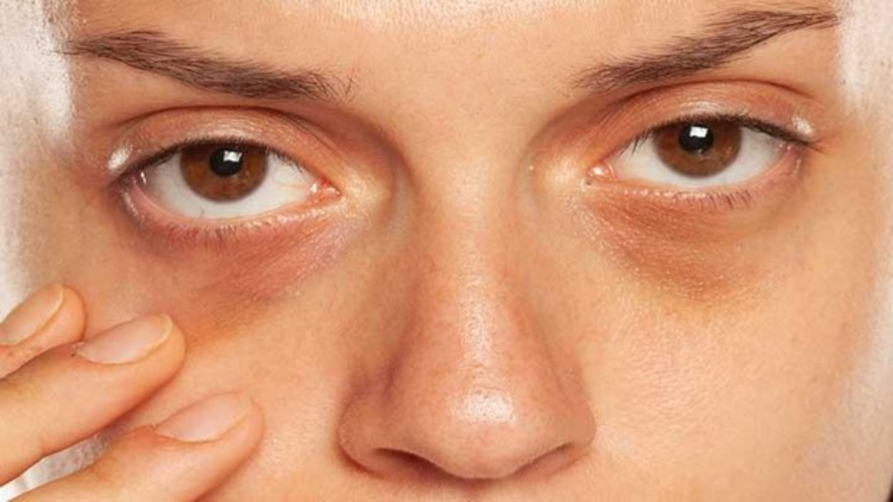 What Causes Dark Circles Under The Eyes? Know The Whole Details